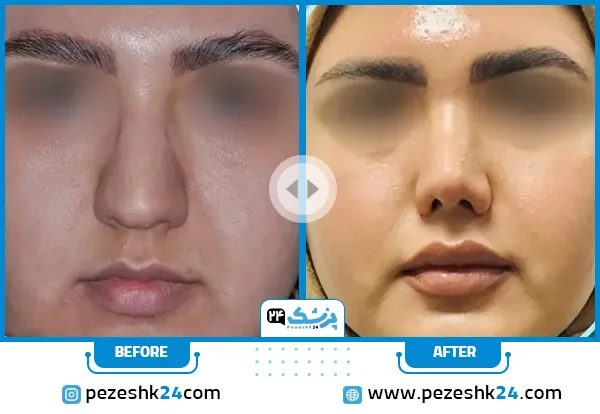 قبل و بعد عمل انحراف بینی دکتر کمندی