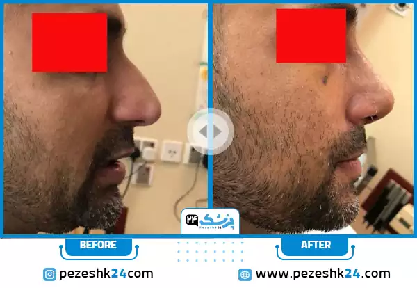 قبل و بعد عمل بینی دکتر عطائی اصفهان