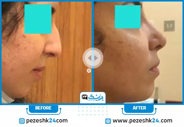 قبل و بعد جراحی بینی دکتر عطائی اصفهان