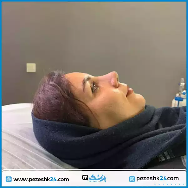 نمونه جراحی بینی دکتر احسان نصیرائی مشهد