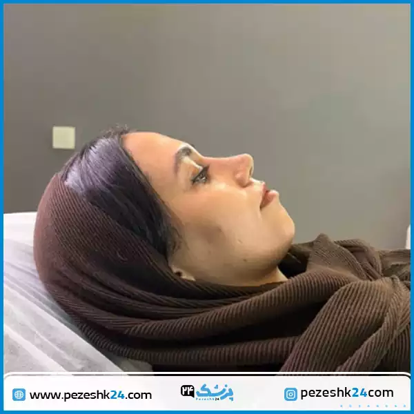 نمونه جراحی بینی دکتر احسان نصیرائی