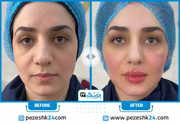نمونه کار فیلر لب و فیلر زاویه سازی صورت در کلینیک ستارگان میرداماد تهران