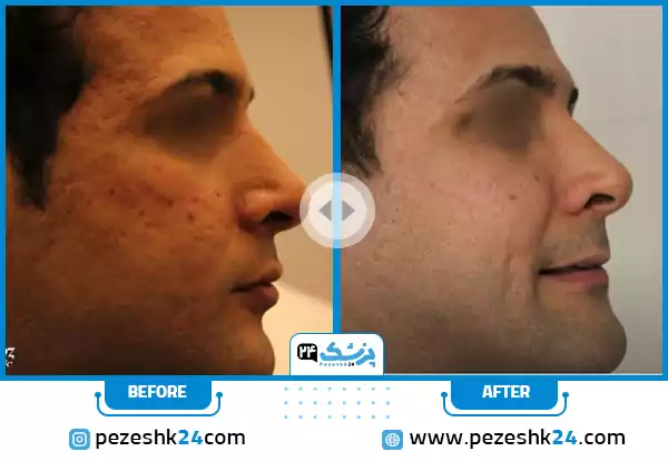 عکس صورت بعد از سابسیژن دکتر باریک بین