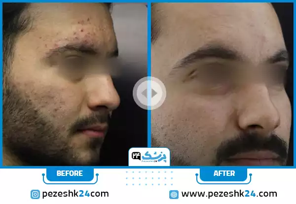 عکس قبل و بعد سابسیژن دکتر باریک بین