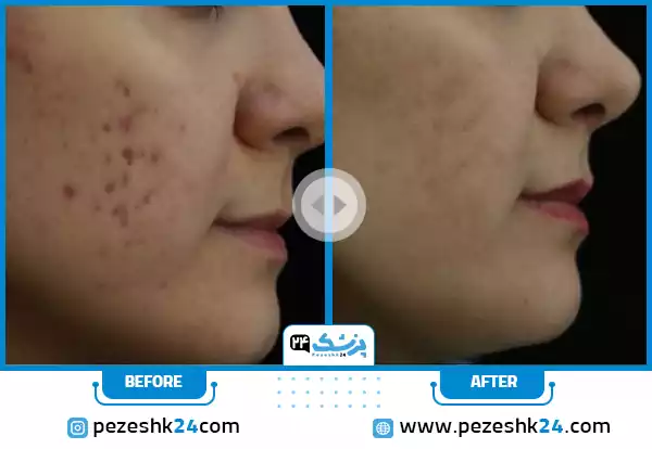 عکس سابسیژن برای منافذ باز پوست دکتر باریک بین