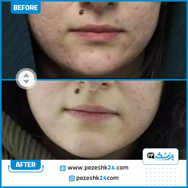 عکس سابسیژن پوست دکتر باریک بین