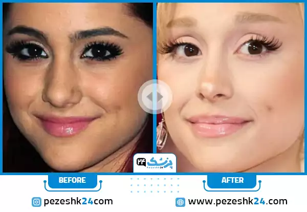 مدل بینی اروپایی آریانا گرانده