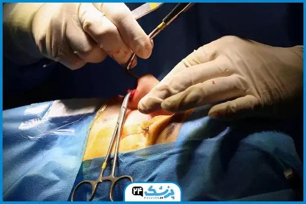 مرحله سوم عمل بینی در اتاق عمل؛ ایجاد برش روی بینی