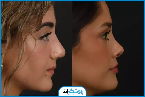 تفاوت عمل بینی اروپایی با مدل فانتزی