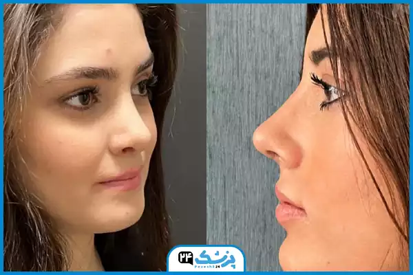 تفاوت عمل بینی مدل اروپایی با مدل طبیعی
