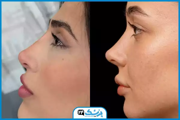 تفاوت مدل عمل بینی اروپایی با سایر مدلهای عمل بینی