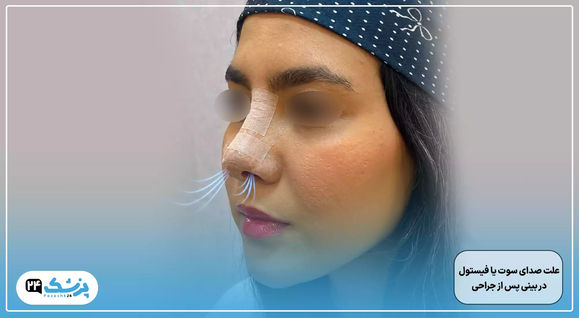 صدای صوت یا فیستول بعد از عمل بینی