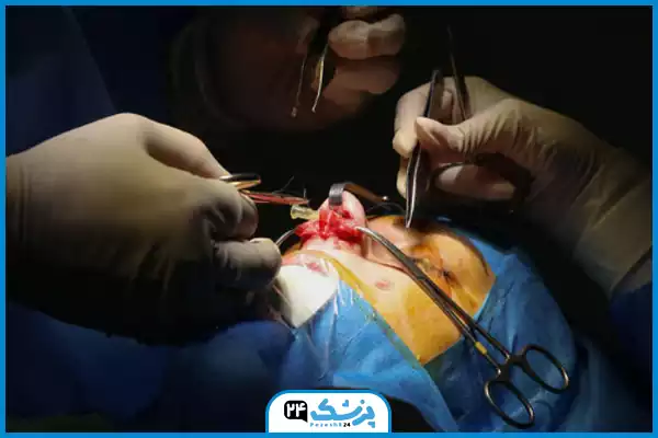 مرحله چهارم عمل بینی؛ اصلاح استخوان و غضروف بینی