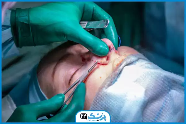 مرحله ششم عمل بینی؛ بخیه و پایان جراحی