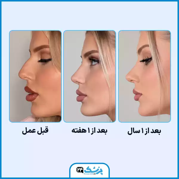 روند کاهش ورم نوک بینی استخوانی