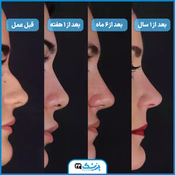 روند کاهش ورم بینی استخوانی از هفته تا یک سال بعد از عمل