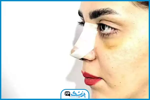 تصویر چسب بینی گوشتی بعد از جراحی