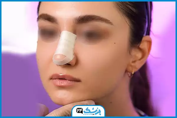 تصویر تاثیر چسب روی اندازه بینی