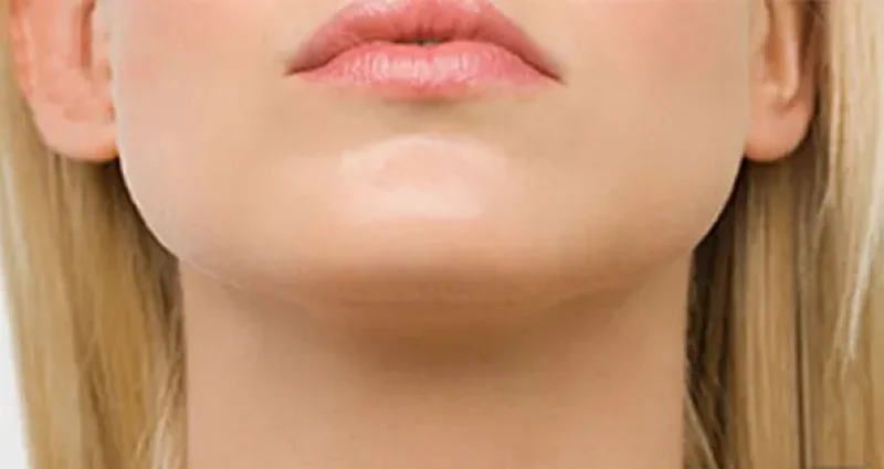جراحی پروتز چانه در رشت