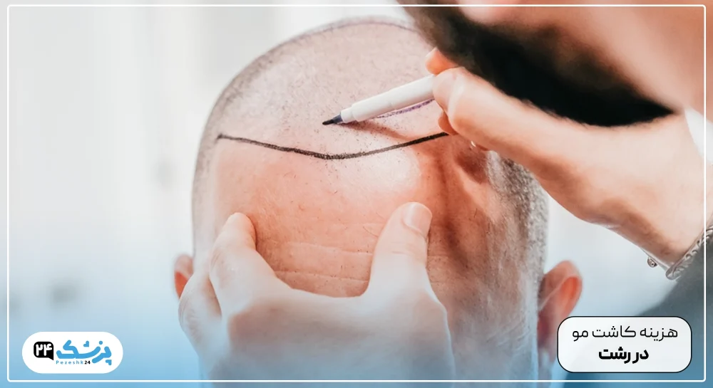 Cost of hair transplant in Rasht