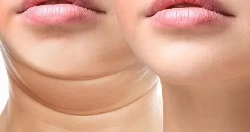 رفع غبغب در مشهد