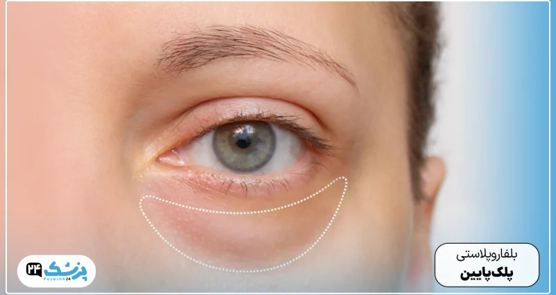 Lower eyelid blepharoplasty