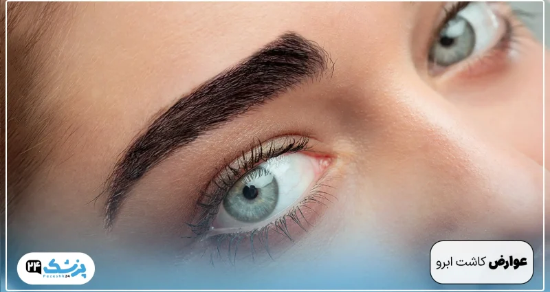 Side effects of eyebrow transplantation