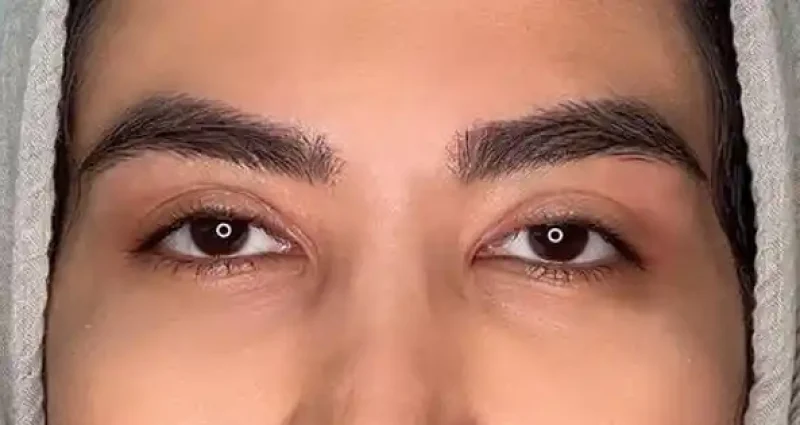 The best blepharoplasty surgeon in Mashhad