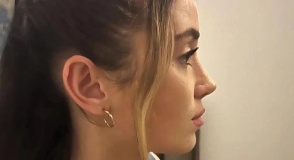 best female nose surgeon in isfahan