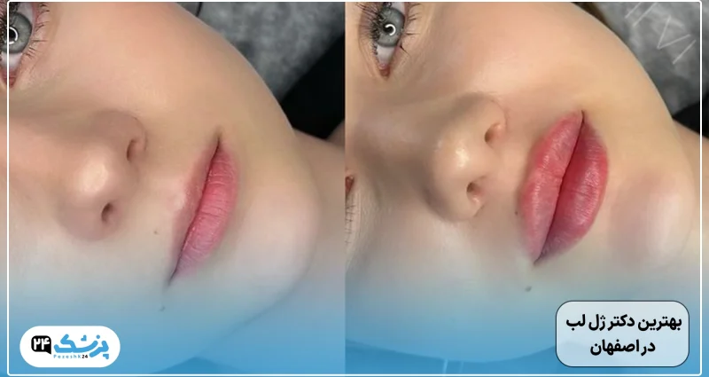 بهترین دکتر تزریق ژل لب اصفهان