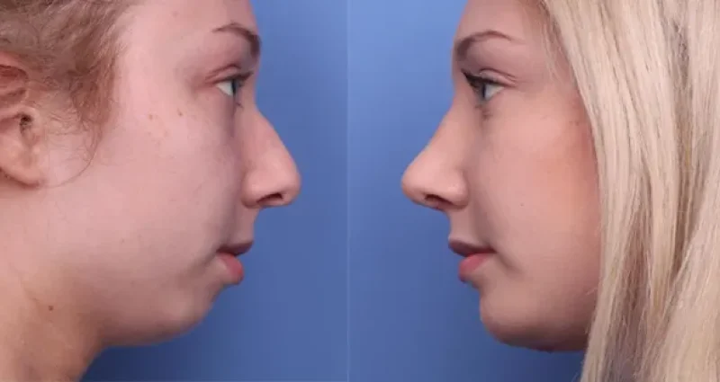 chin-surgery-in-shiraz 1