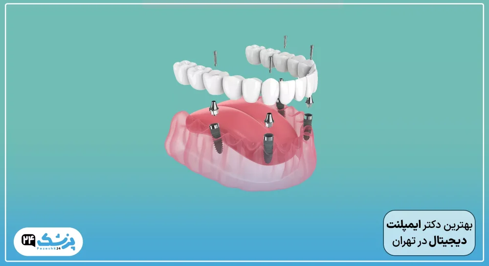 the best digital implant doctor tehran